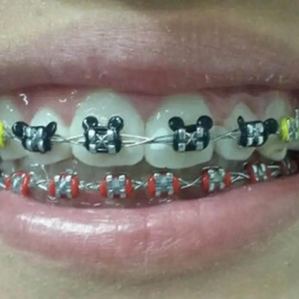 Ligaduras Ortodoncia De Mickey Mouse Colores 1000u Santiago 4