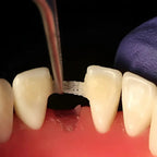 Banda De Refuerzo Dental Tira De Fibra Tipo Ribbon 1 Rollo 13