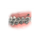 Micro Tornillo Extraradicular D:2mm-TM4mm - 1/Pack