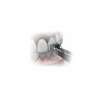 Pinza de Bracket Morelli