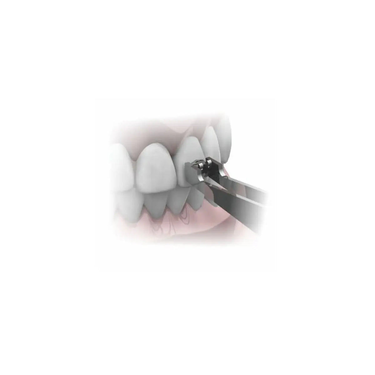 Pinza de Bracket Morelli