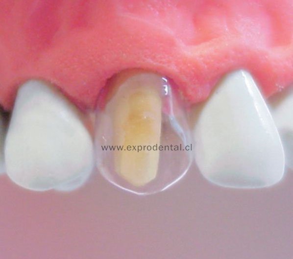 Corona Trans Inf Ant X54 Tdv (4154)