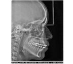 Rx Ext 2D/C X-Mind Prime 1S Acteon