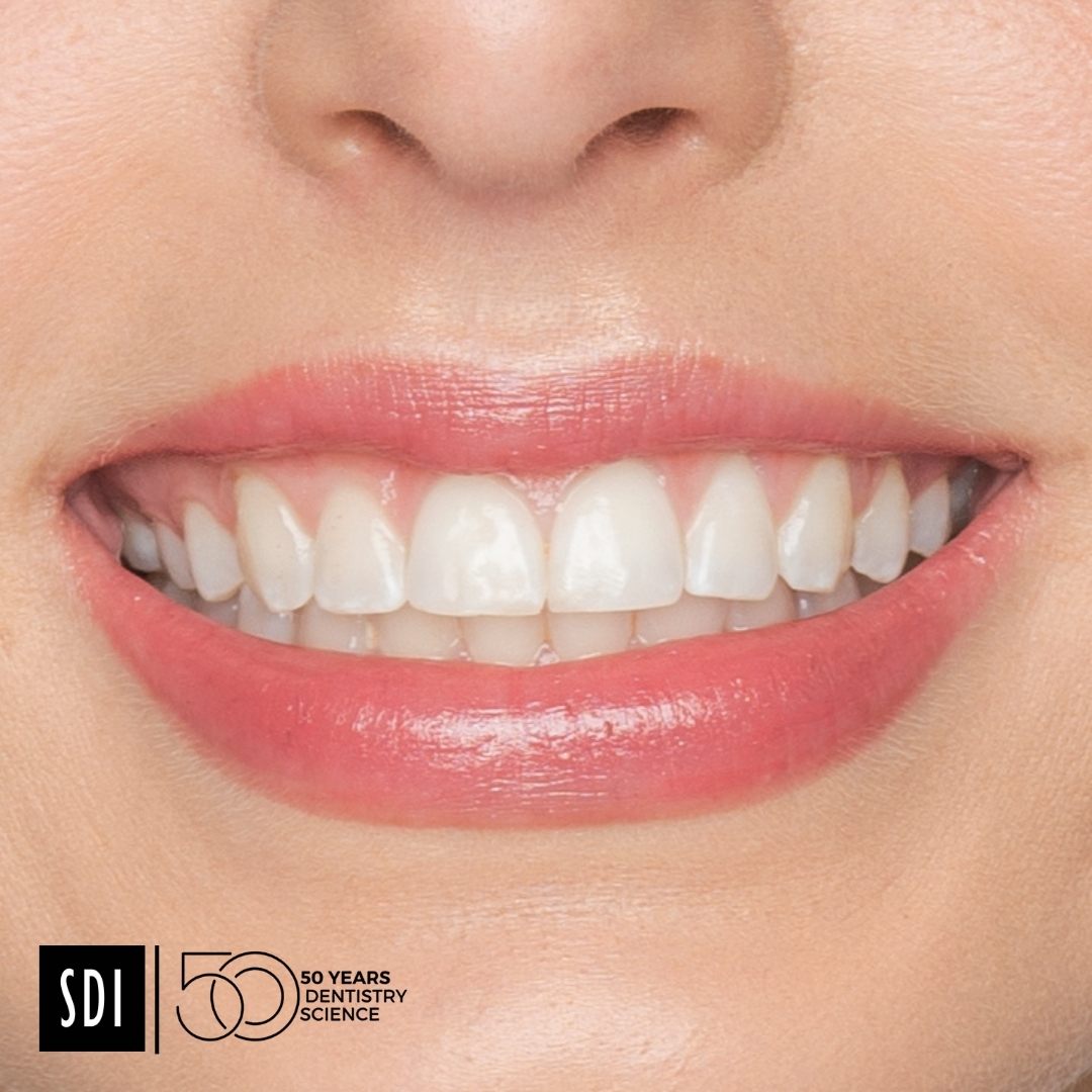SDI Pola Night – Blanqueamiento Dental Peróxido de Carbamida 16%