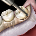 Bone Removal