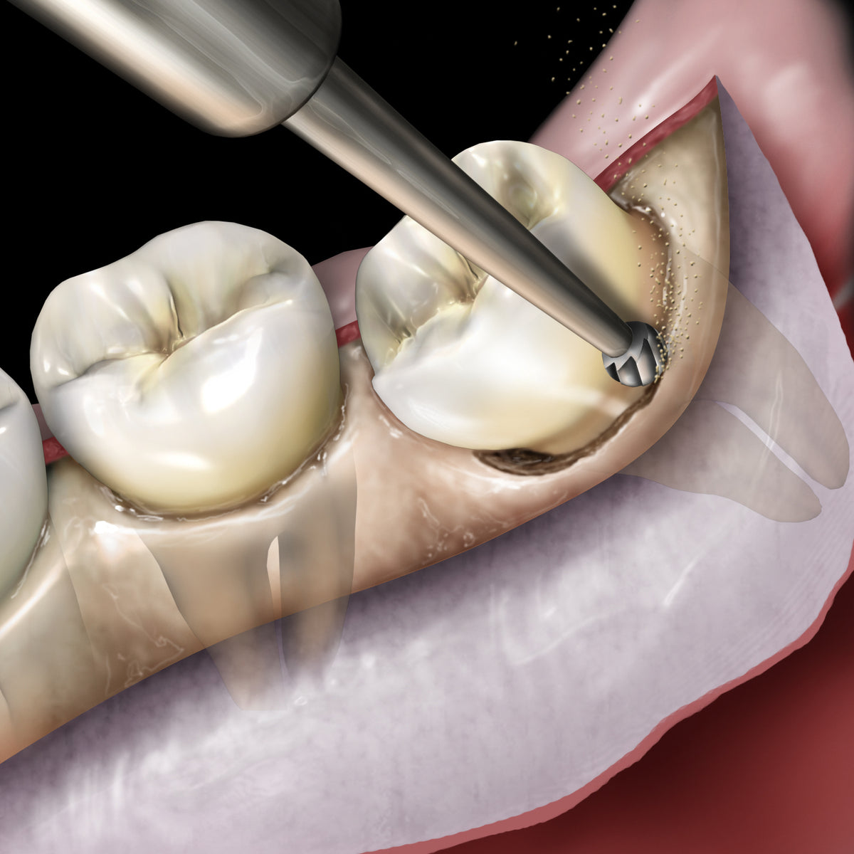 Bone Removal