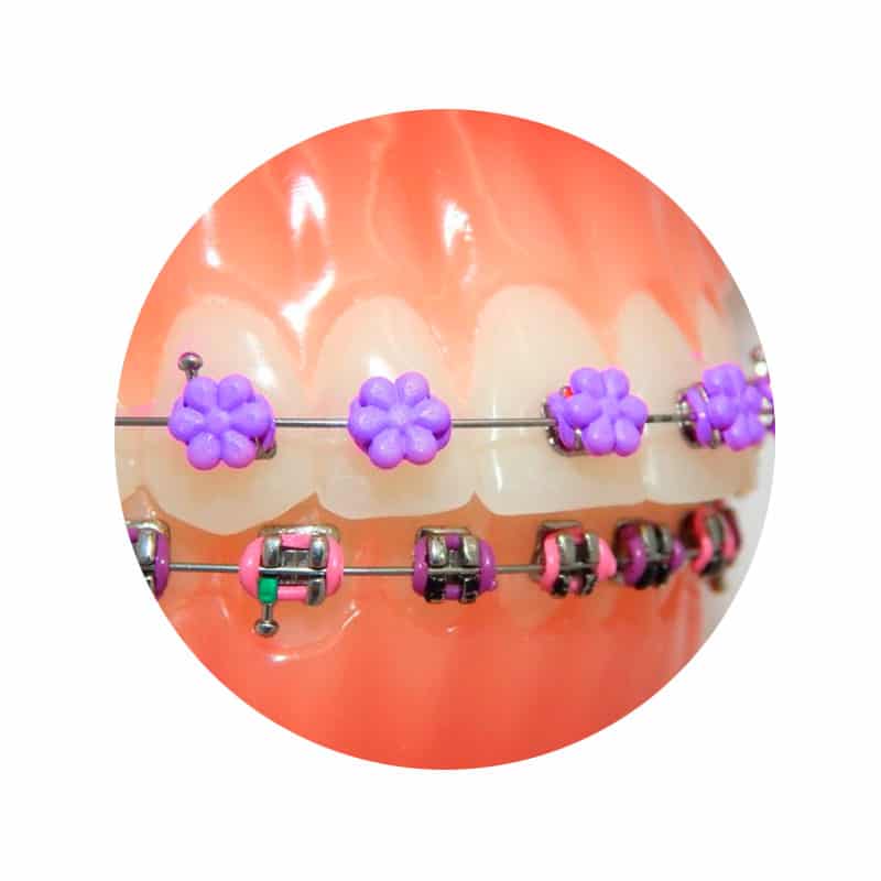 Ligadura DesignerTies | G&H Orthodontics