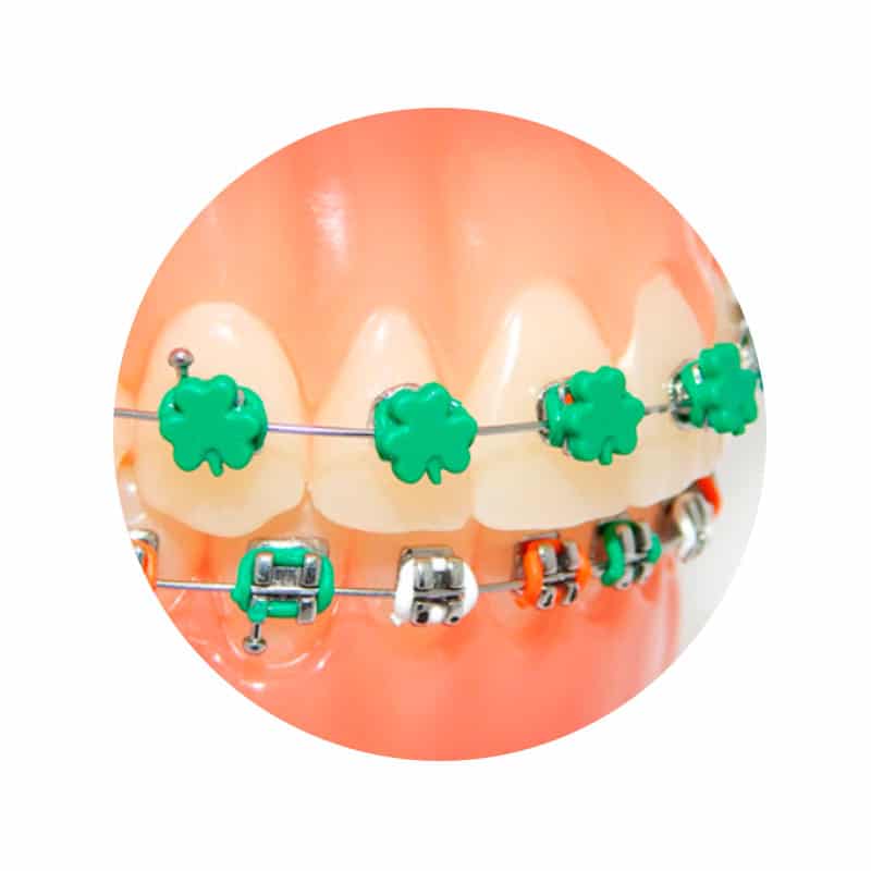 Ligadura DesignerTies | G&H Orthodontics