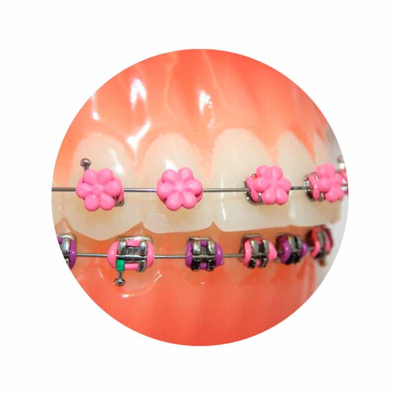 Ligadura DesignerTies | G&H Orthodontics