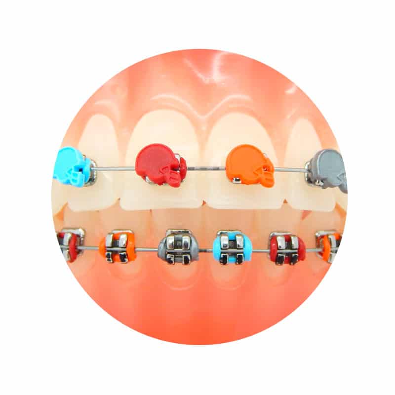 Ligadura DesignerTies | G&H Orthodontics