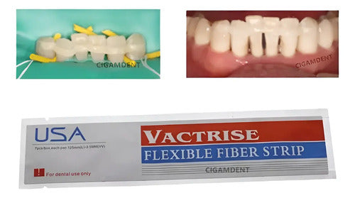 Banda De Refuerzo Dental Tira De Fibra Tipo Ribbond Calidad