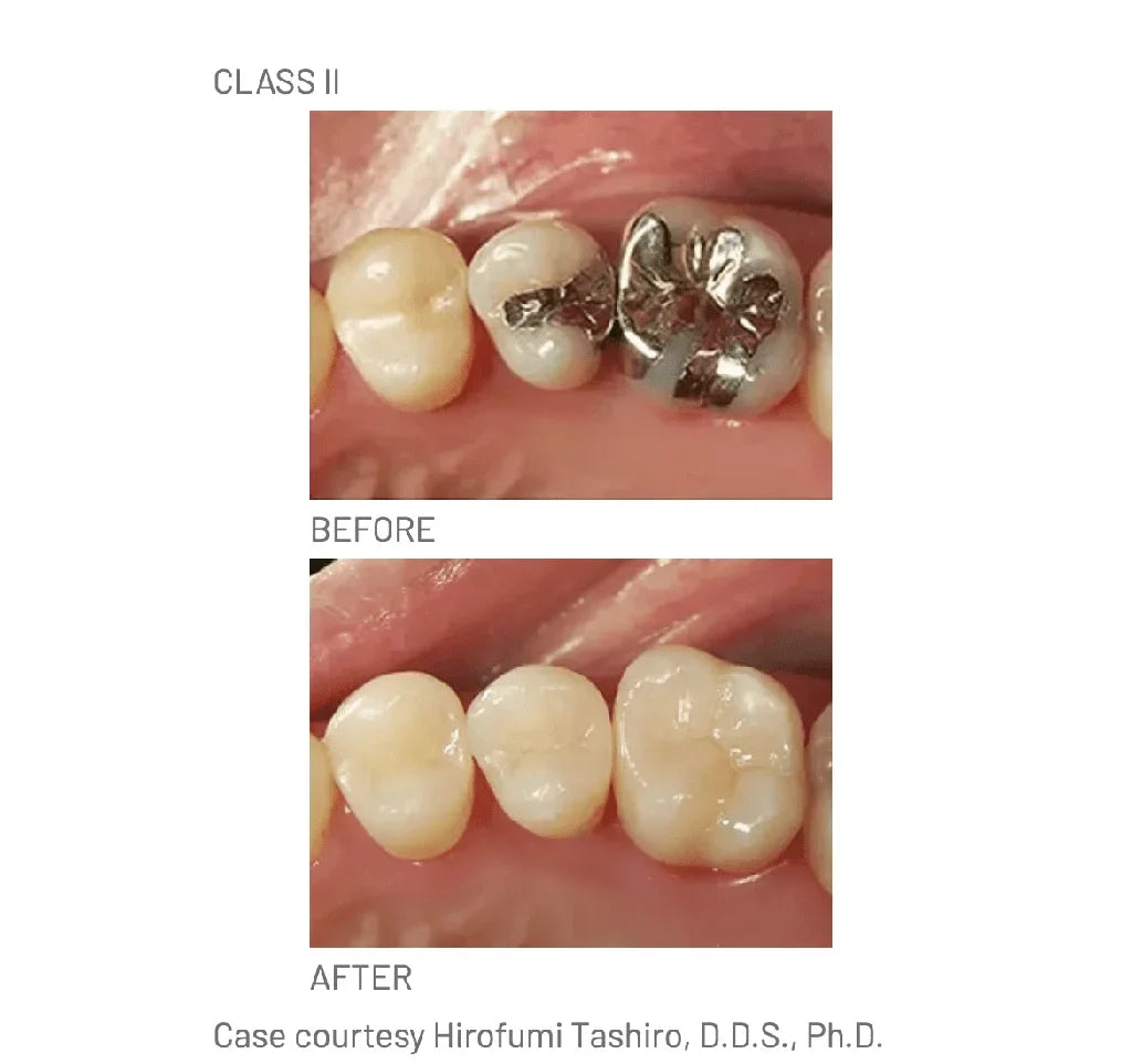 Composite Palfique LX5 Tokuyama