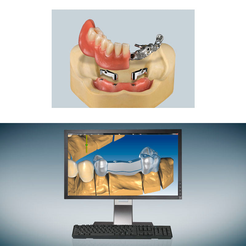 Ceramill M-bars | Software para barras