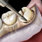 Third Molar Sectioning