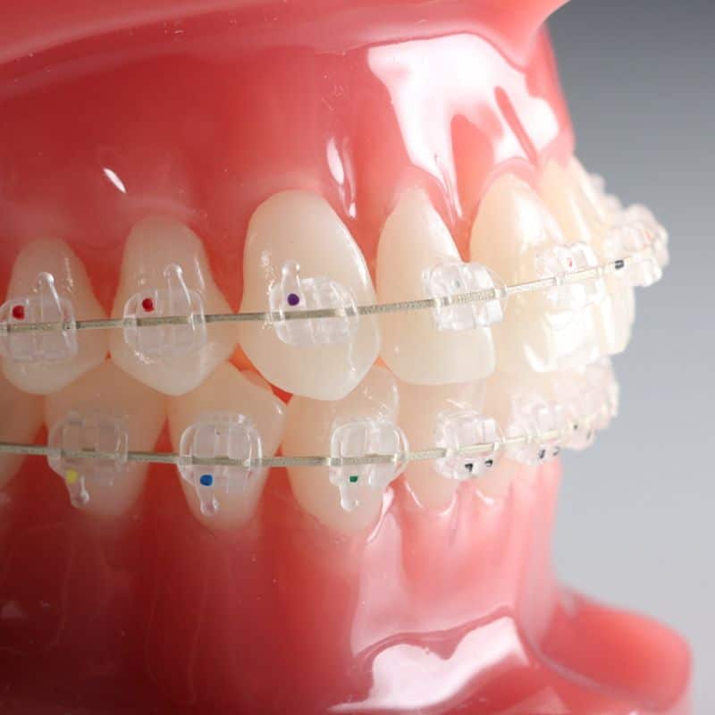 Kit Bracket Cerámico Agility .022 | G&H Orthodontics