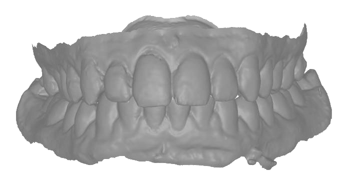 biteSTL-2b