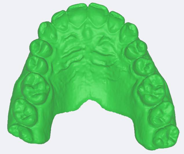 oclusal-1