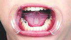 Separador Labial-Abreboca con Retractor Lingual