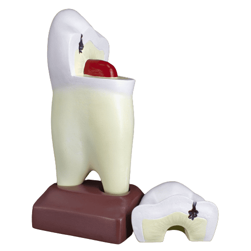 Macromodelo Premolar Magnético Machtig